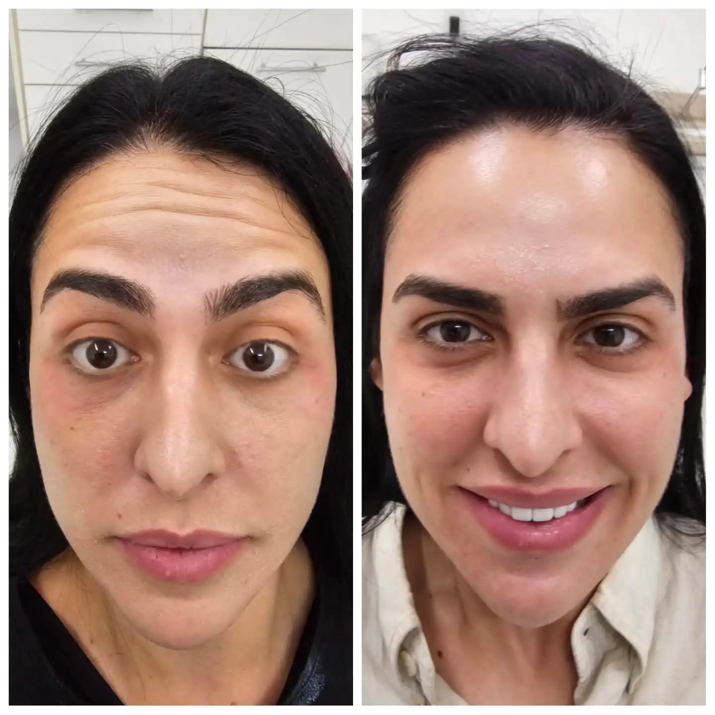 Resultado real de aplicação de BOTOX® — 18