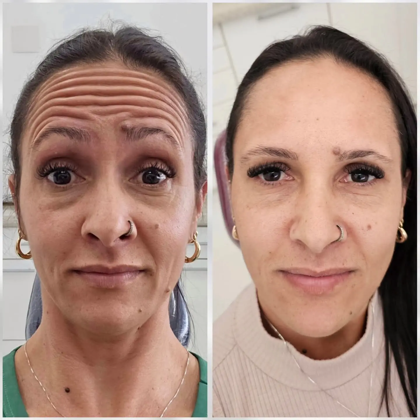 Resultado real de aplicação de BOTOX® — 19