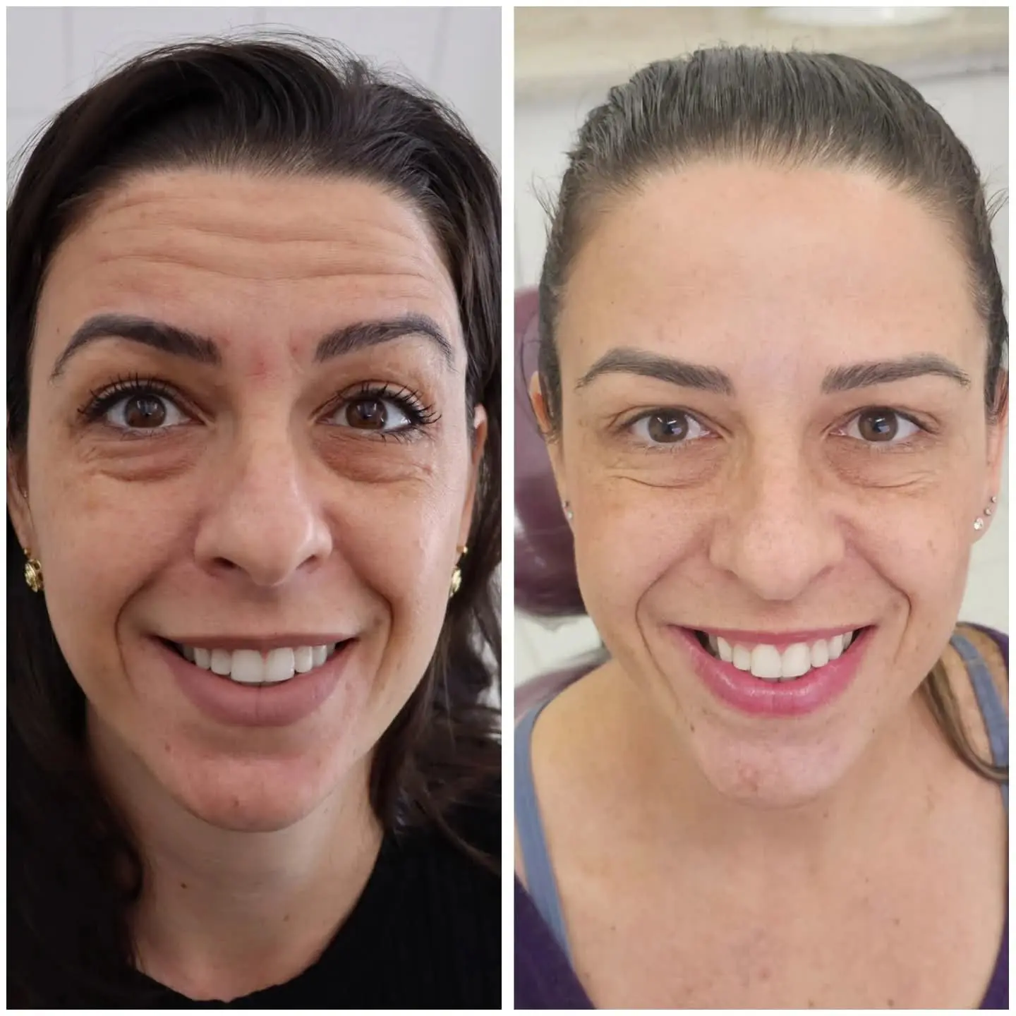 Resultado real de aplicação de BOTOX® — 20