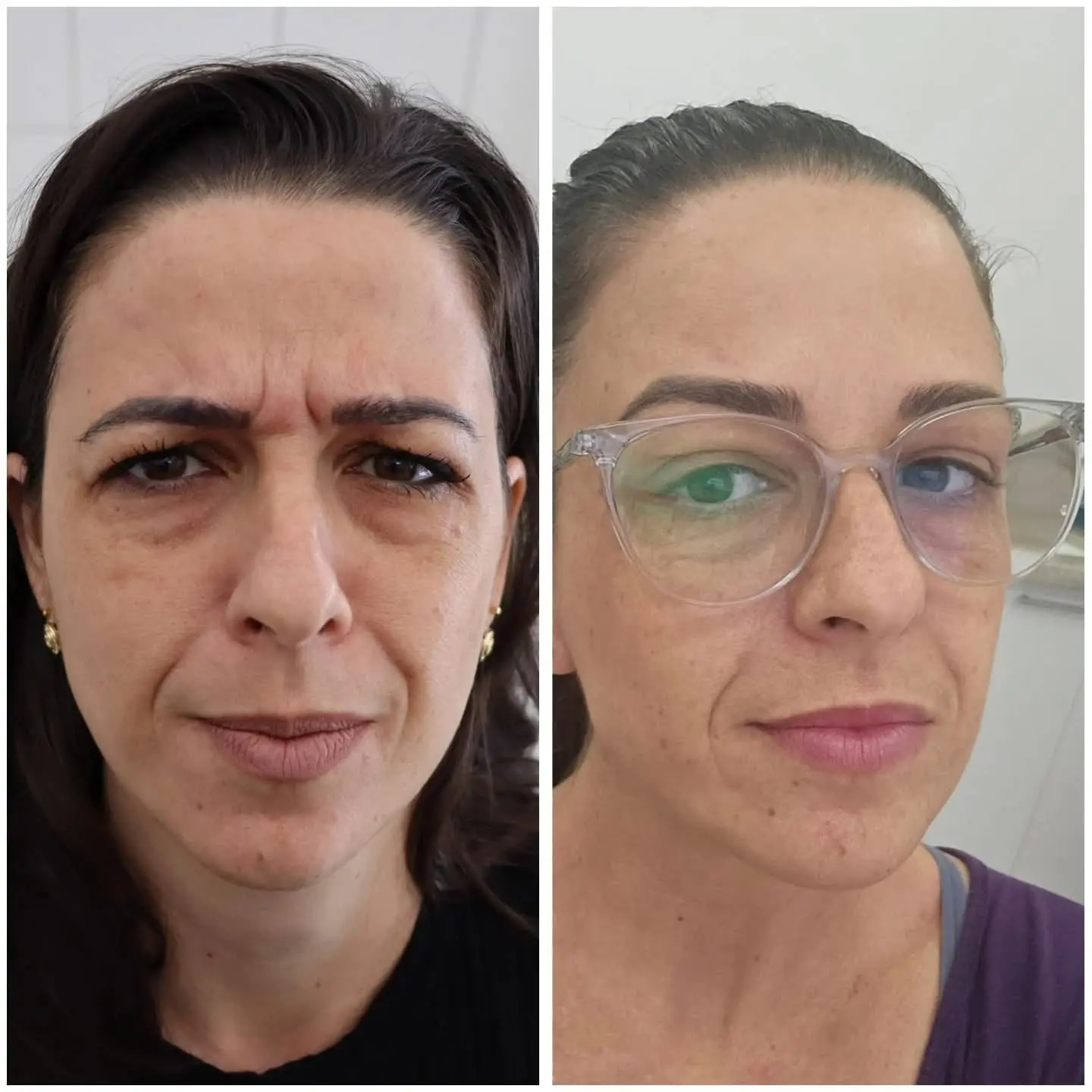 Resultado real de aplicação de BOTOX® — 21