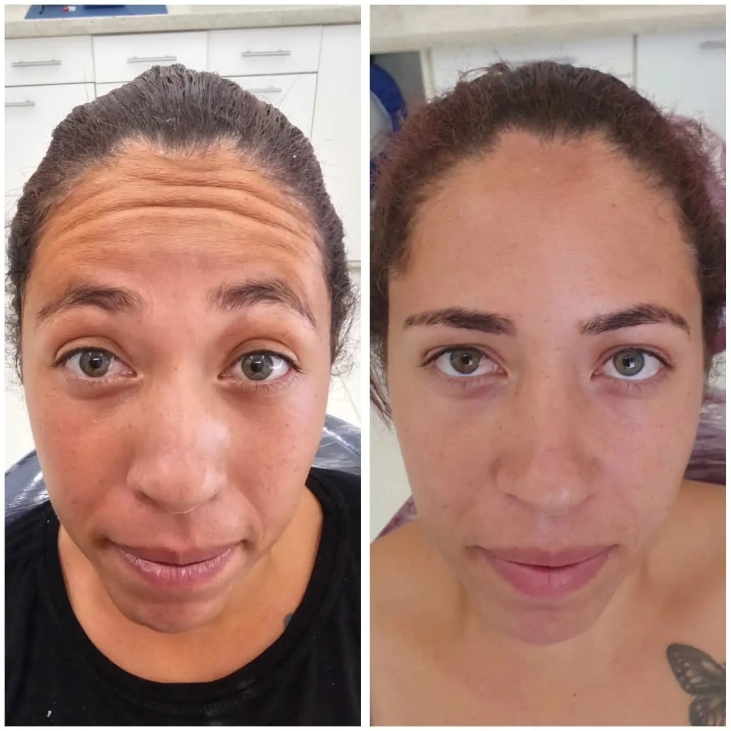 Resultado real de aplicação de BOTOX® — 22