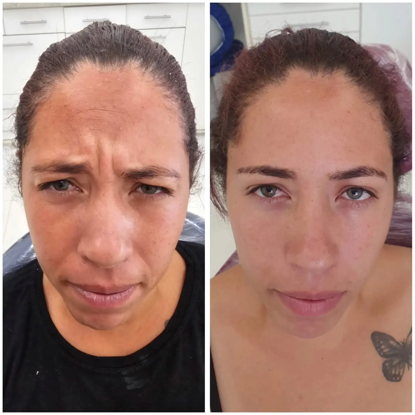 Resultado real de aplicação de BOTOX® — 23