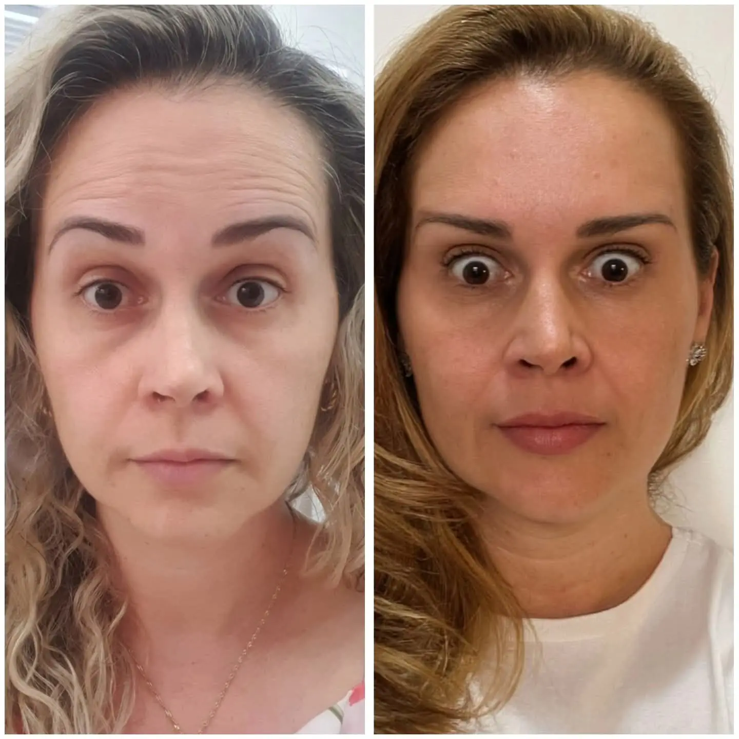 Resultado real de aplicação de BOTOX® — 24