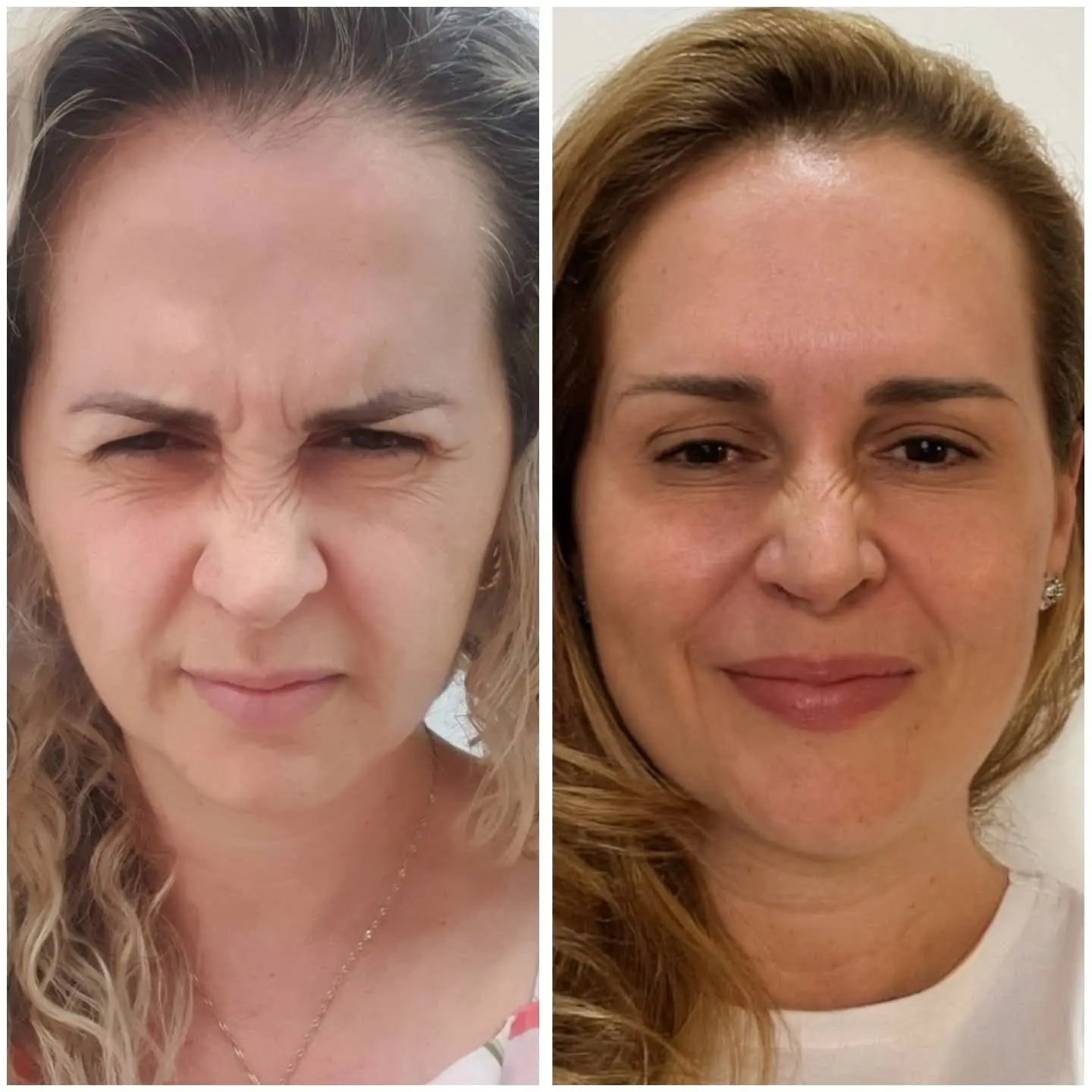 Resultado real de aplicação de BOTOX® — 25