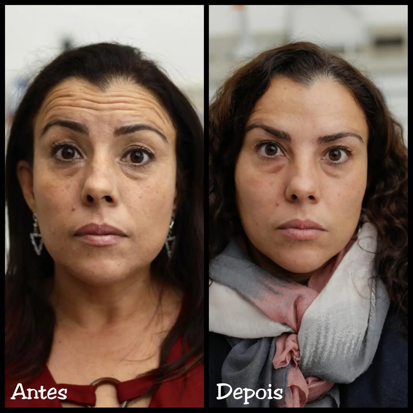 Resultado real de aplicação de BOTOX® — 26