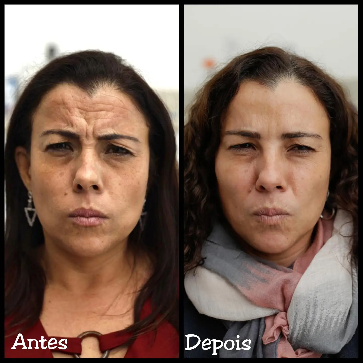 Resultado real de aplicação de BOTOX® — 27