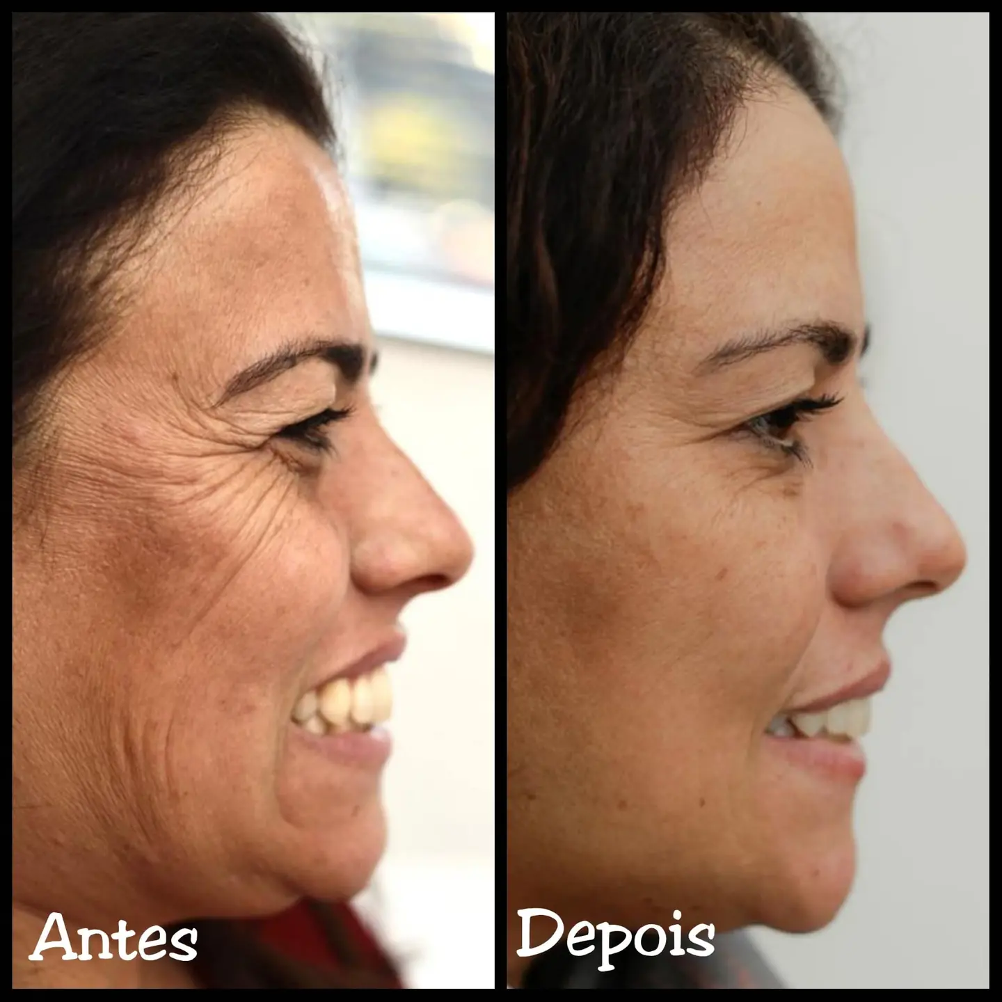 Resultado real de aplicação de BOTOX® — 28