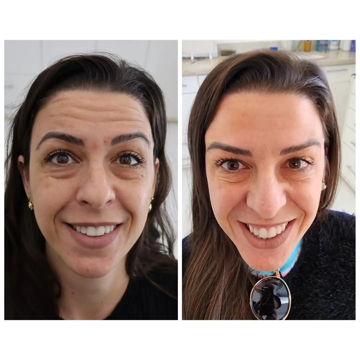 Resultado real de aplicação de BOTOX® — 29
