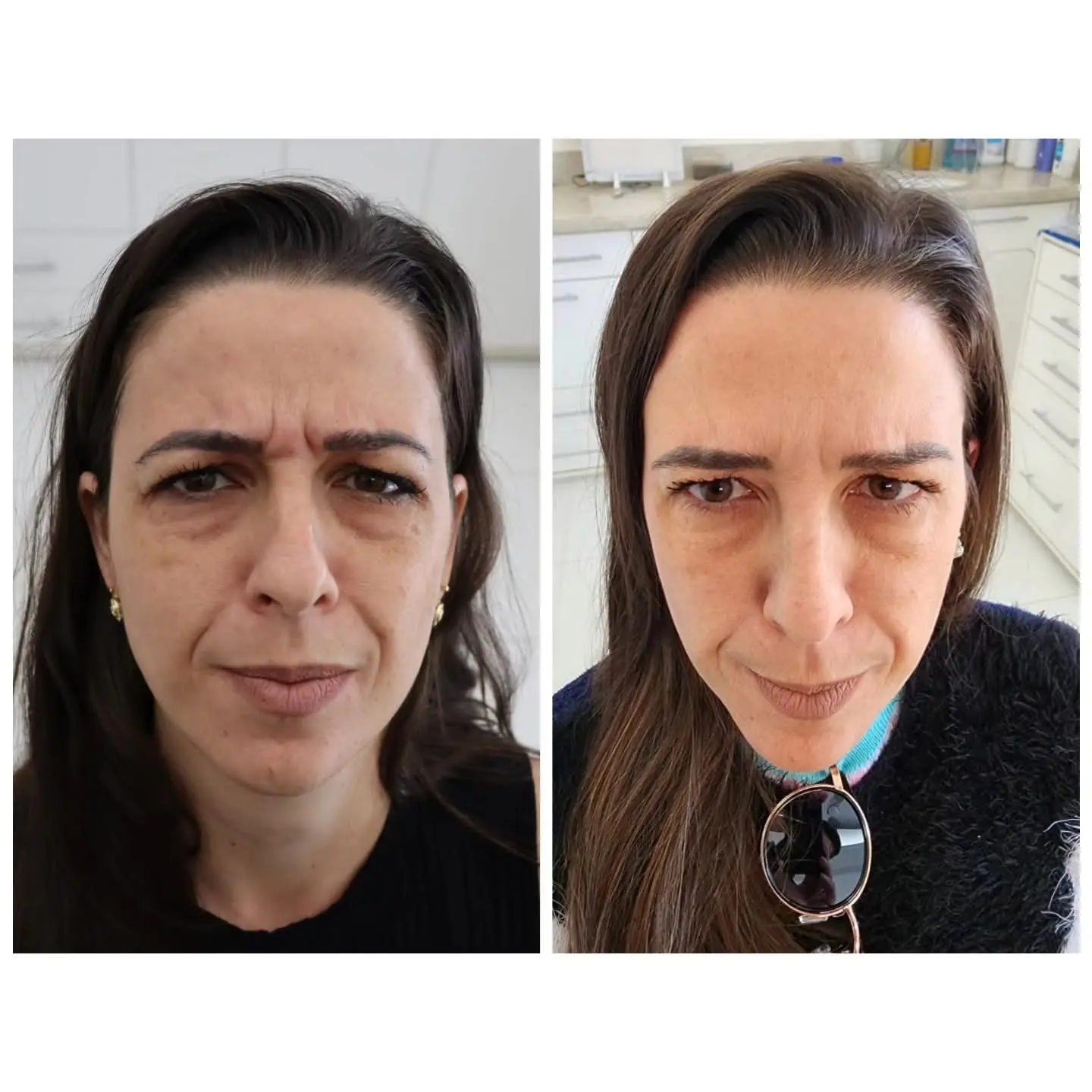 Resultado real de aplicação de BOTOX® — 30