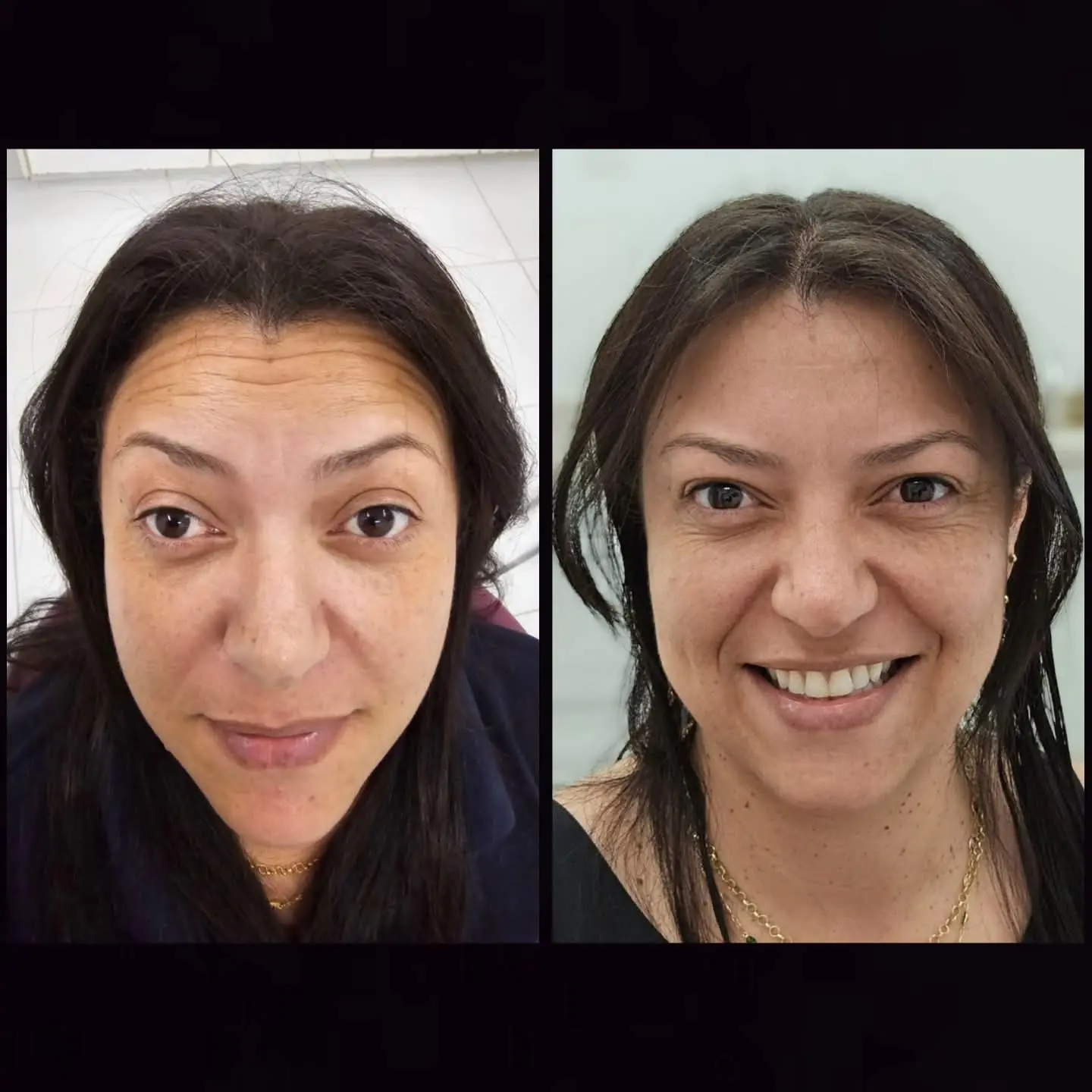 Resultado real de aplicação de BOTOX® — 31