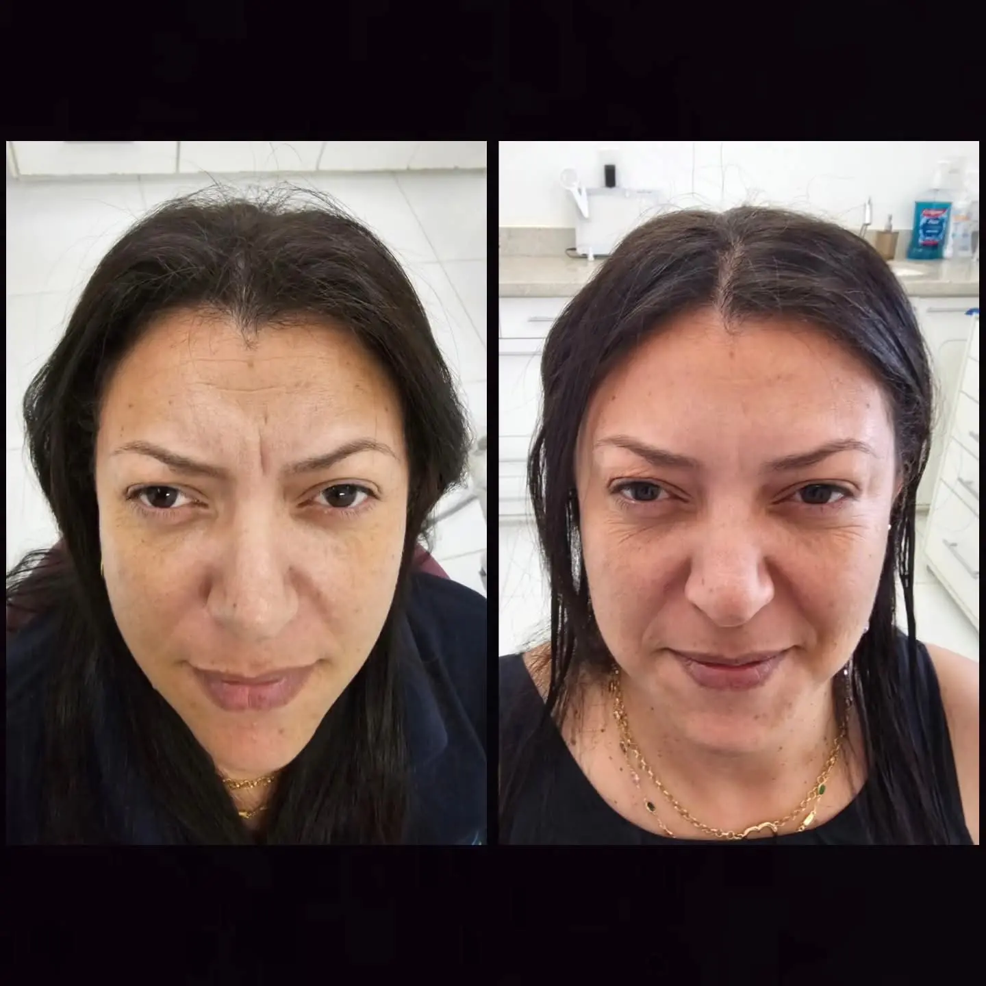 Resultado real de aplicação de BOTOX® — 32
