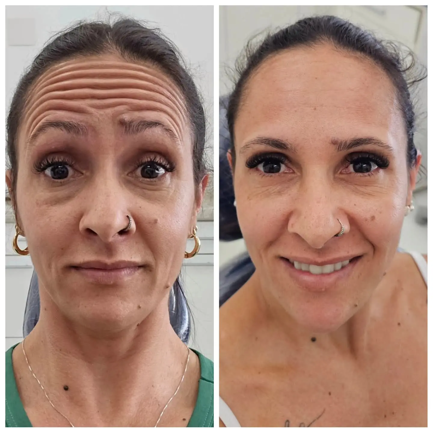 Resultado real de aplicação de BOTOX® — 33
