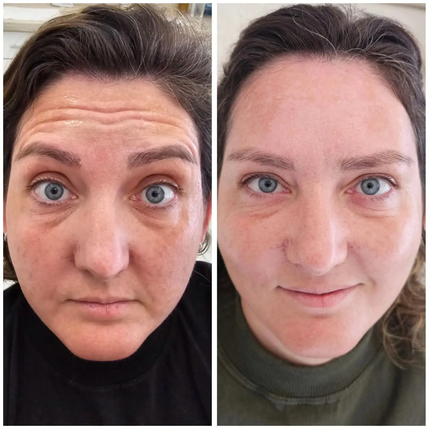 Resultado real de aplicação de BOTOX® — 34