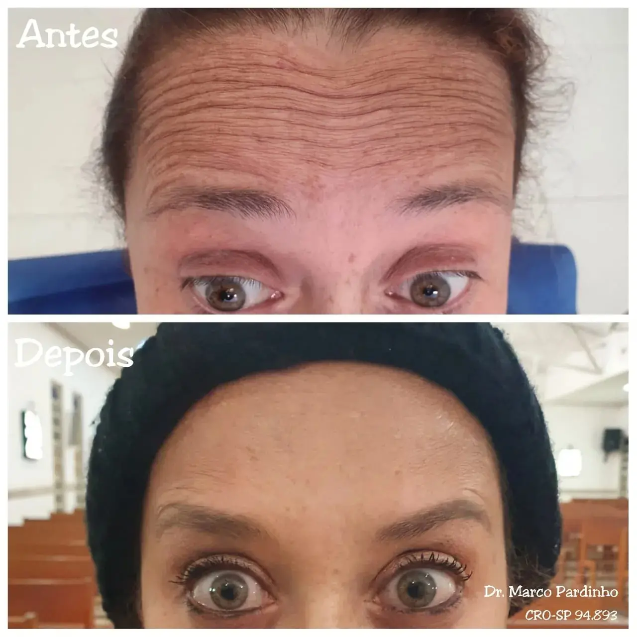 Resultado real de aplicação de BOTOX® — 35