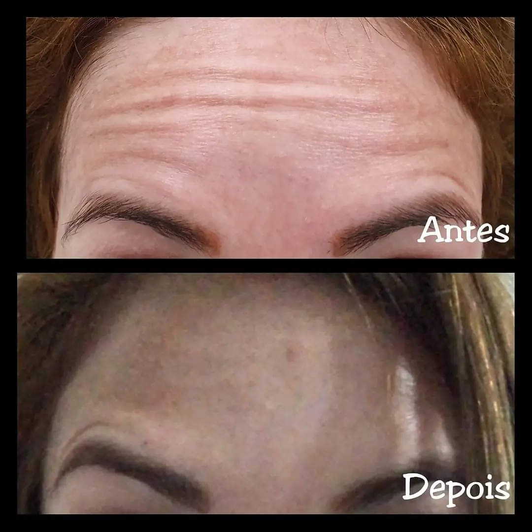Resultado real de aplicação de BOTOX® — 36