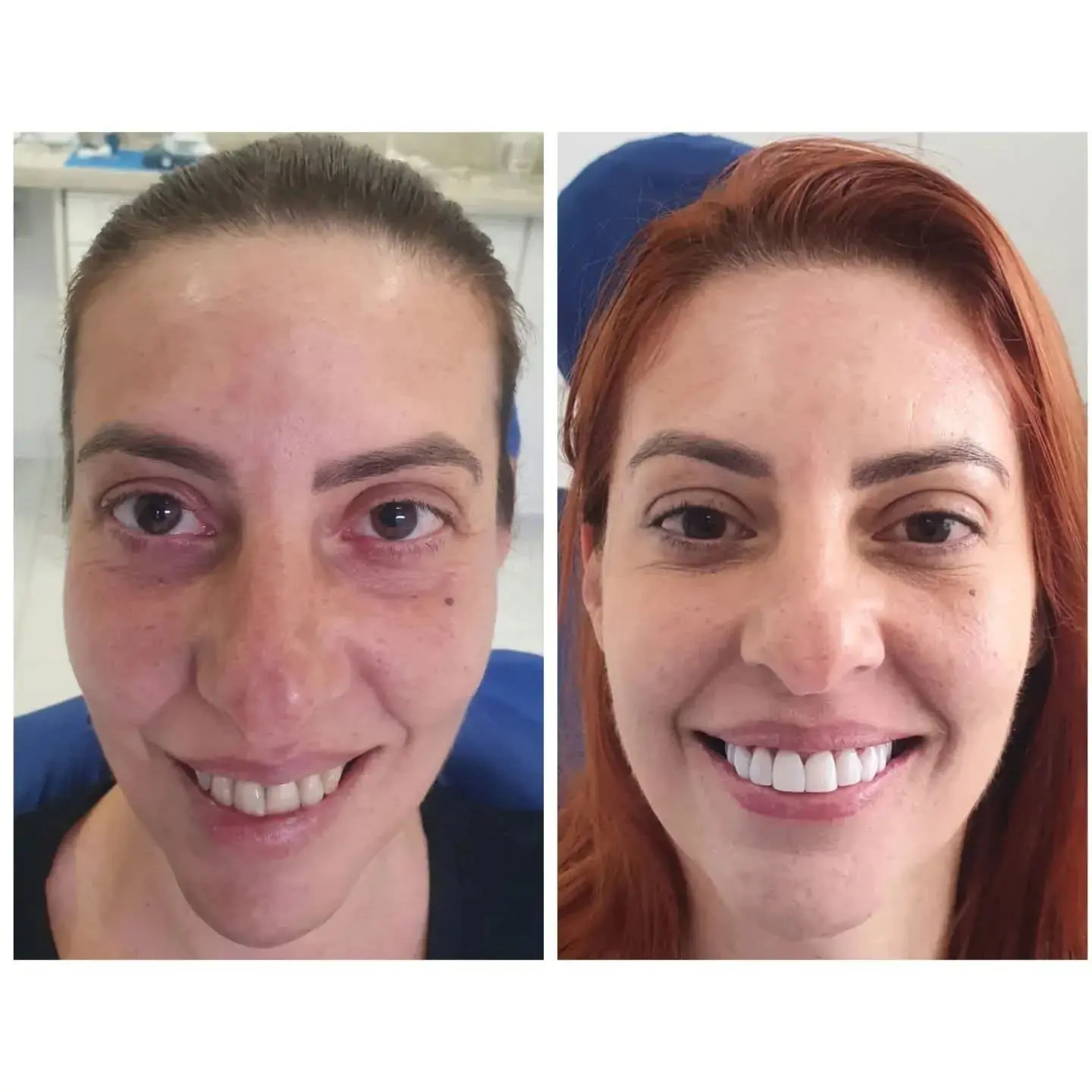Resultado real de aplicação de BOTOX® — 37