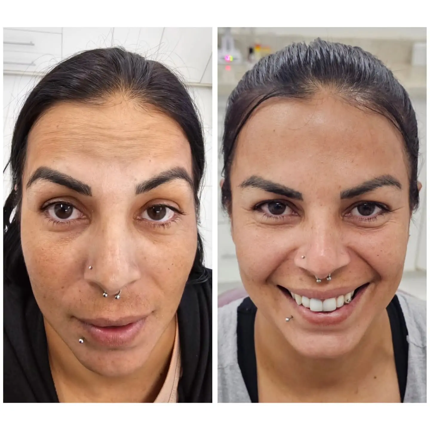 Resultado real de aplicação de BOTOX® — 38