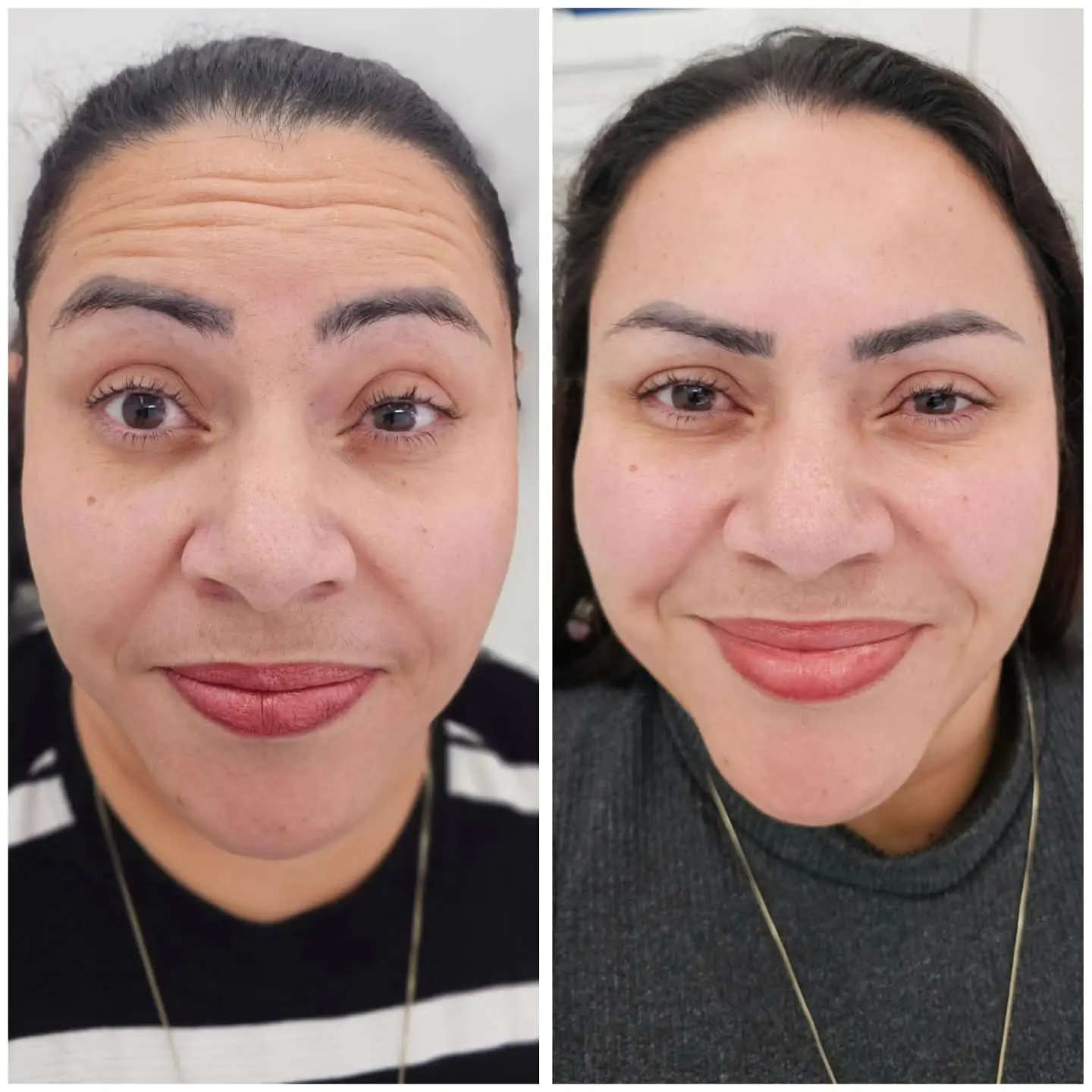 Resultado real de aplicação de BOTOX® — 39