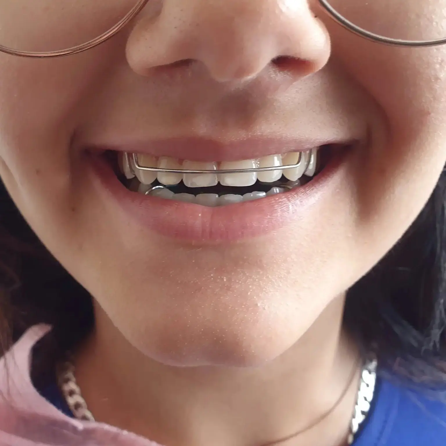 Sorriso de paciente utilizando aparelho ortopédico