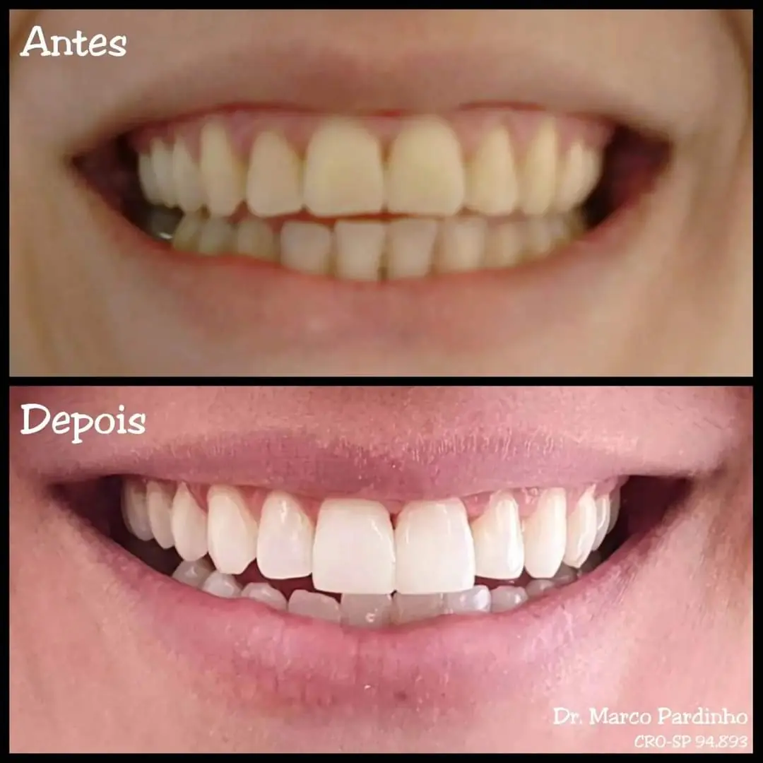 Caso real de clareamento ou lentes — 21