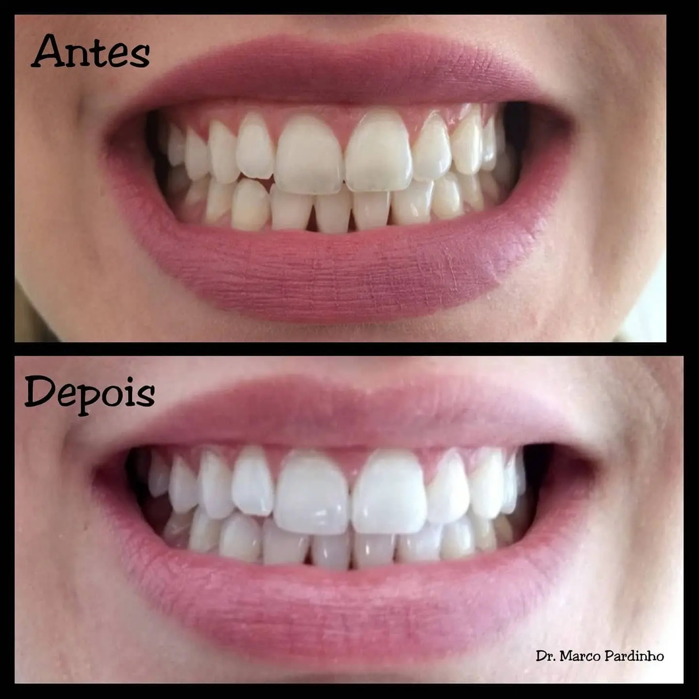 Caso real de clareamento ou lentes — 25