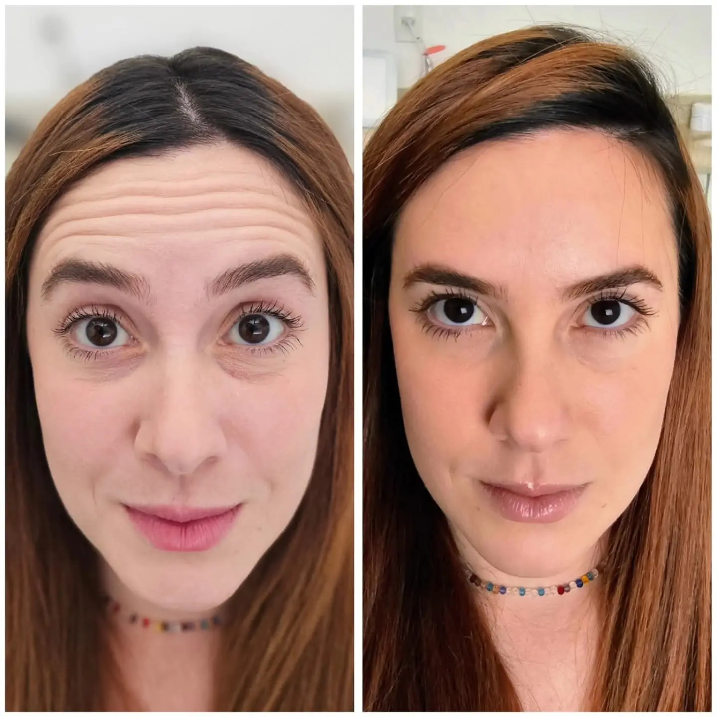 Antes e depois de BOTOX e harmonização orofacial — caso 1