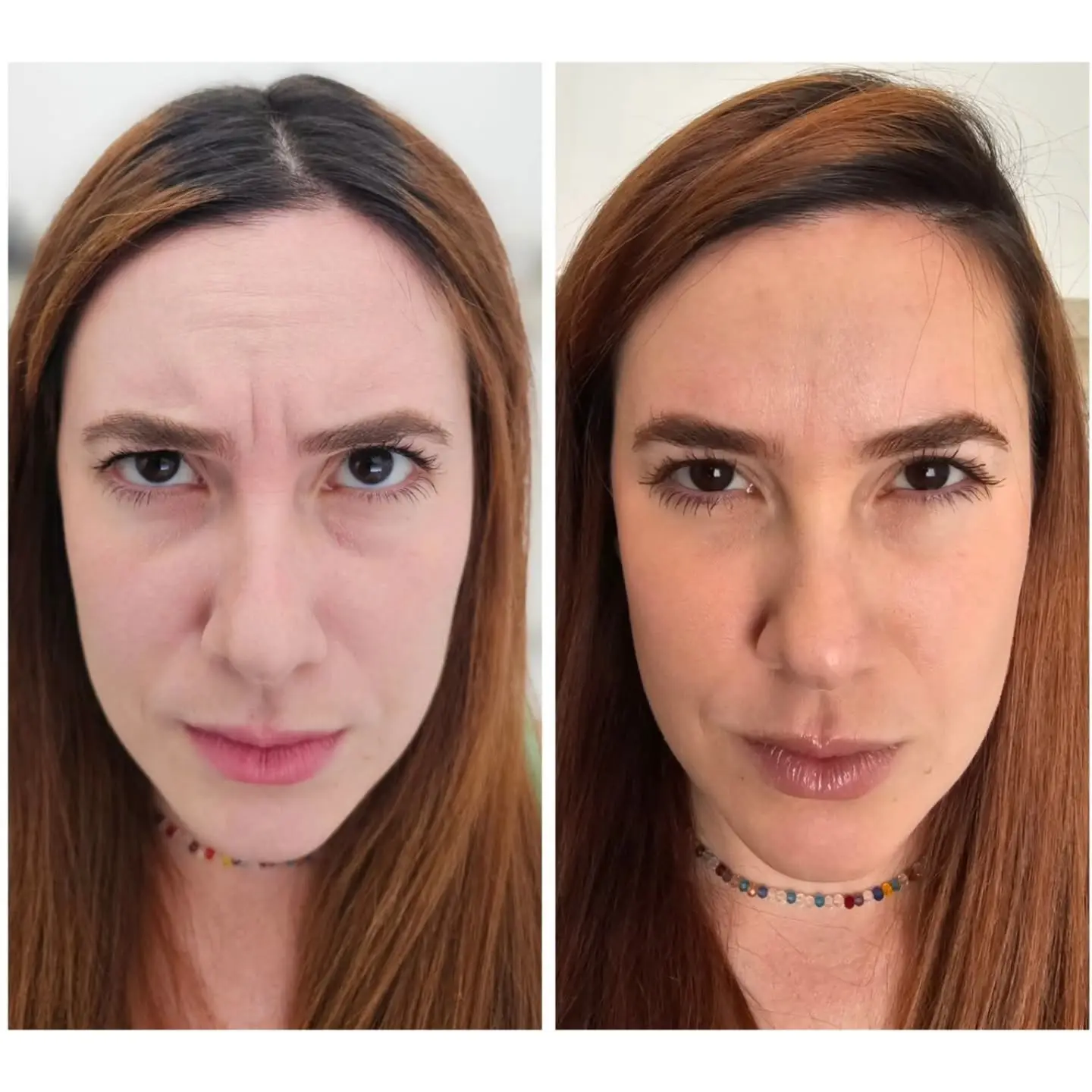 Antes e depois de BOTOX e harmonização orofacial — caso 2