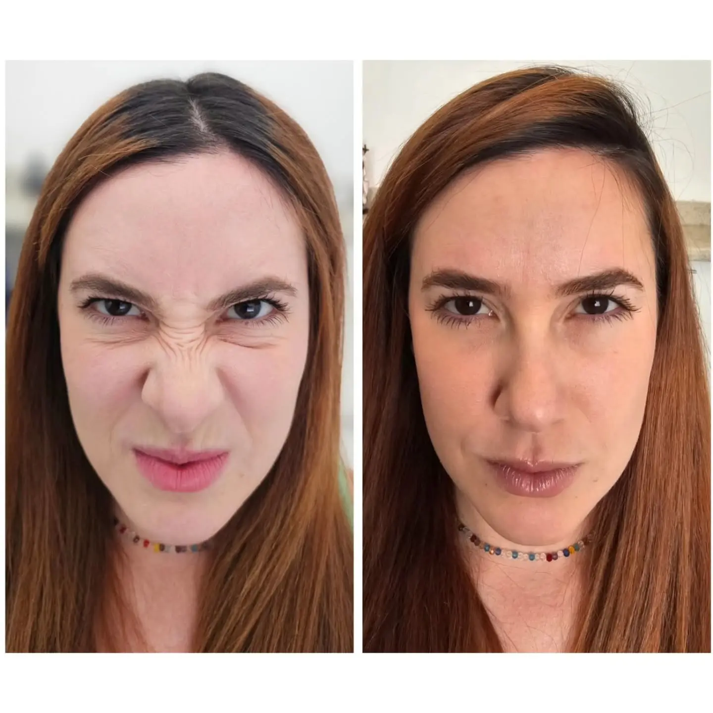 Antes e depois de BOTOX e harmonização orofacial — caso 3