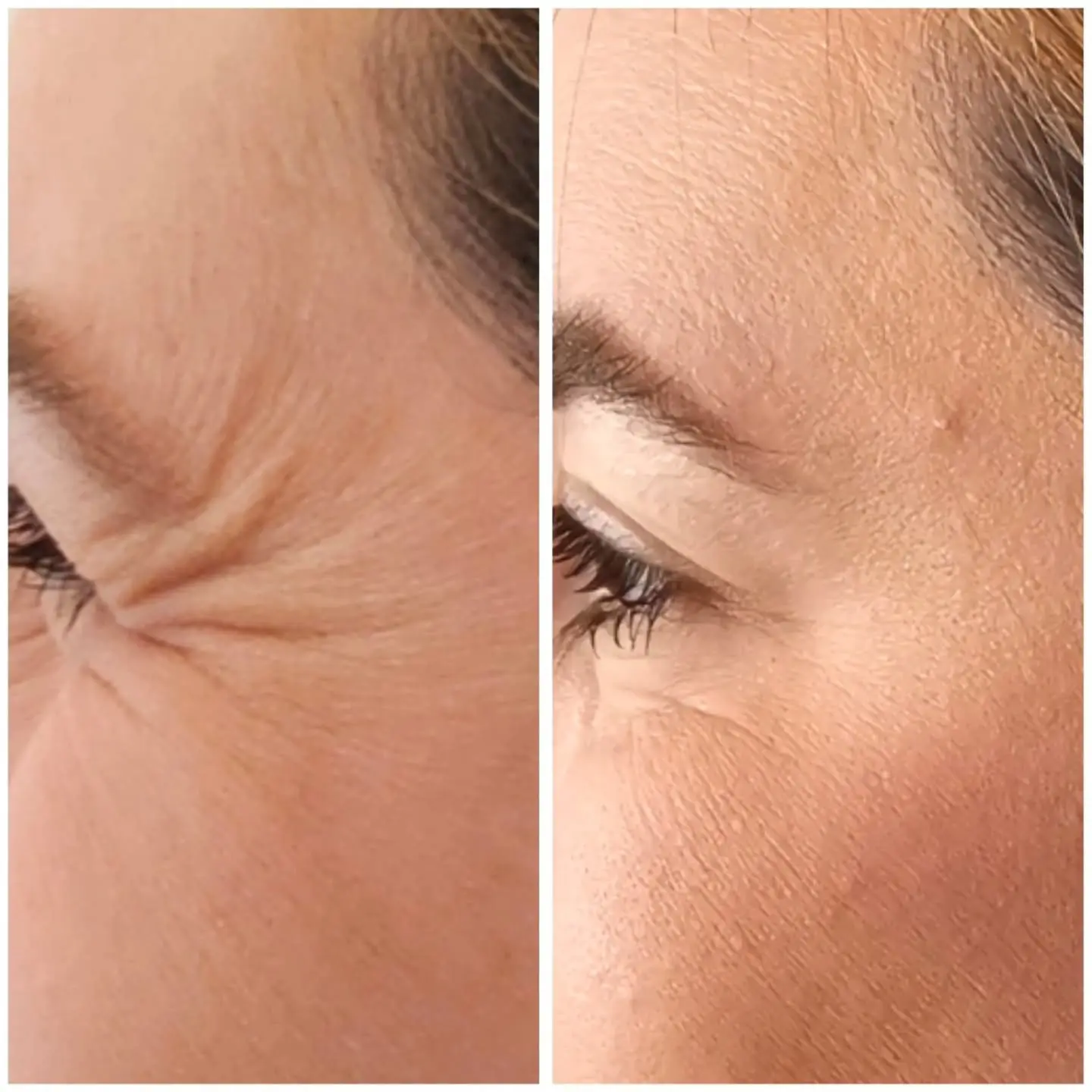 Antes e depois de BOTOX e harmonização orofacial — caso 4
