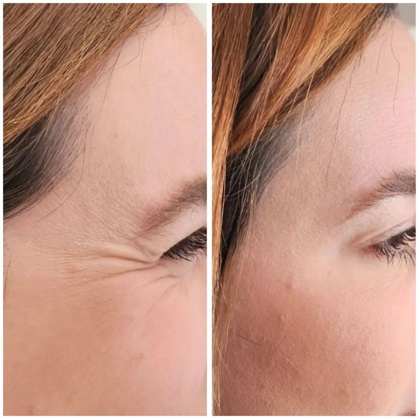 Antes e depois de BOTOX e harmonização orofacial — caso 5