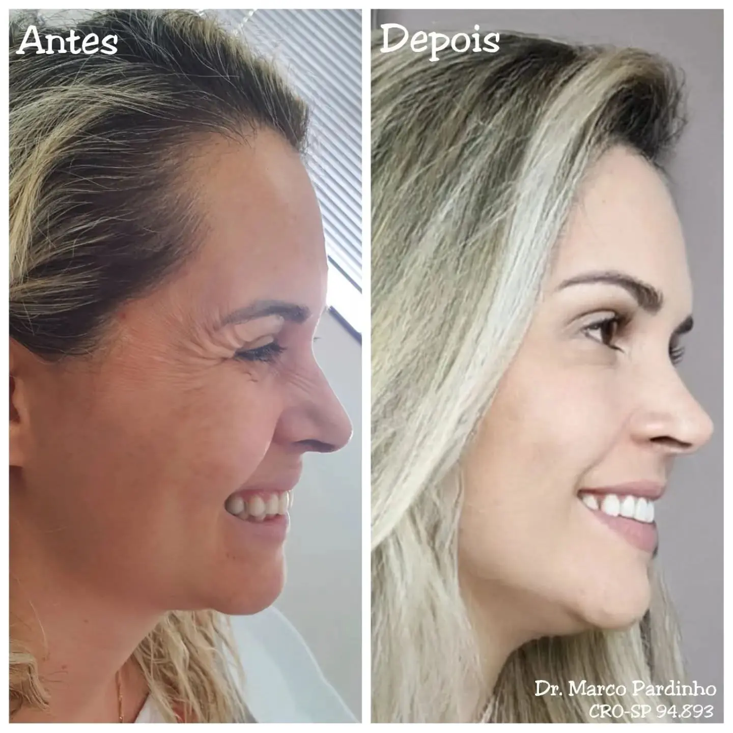 Antes e depois de BOTOX e harmonização orofacial — caso 8