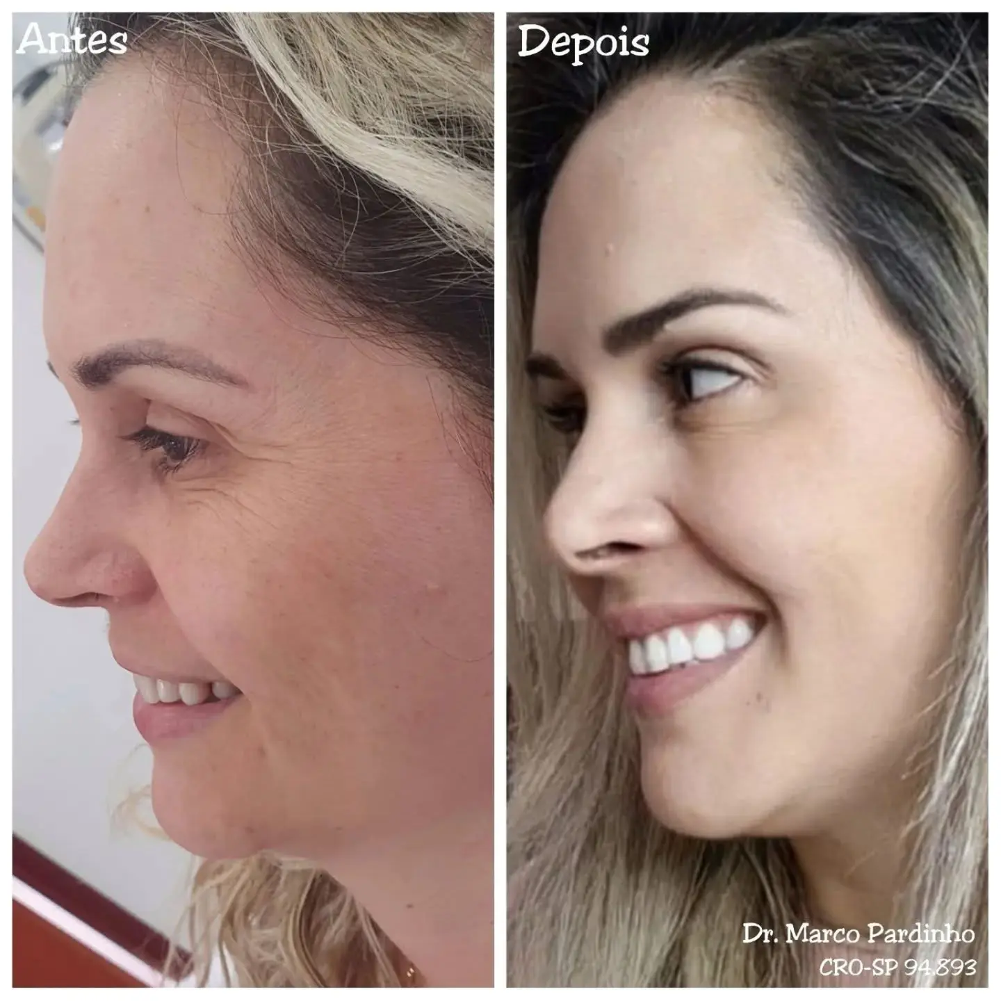 Antes e depois de BOTOX e harmonização orofacial — caso 9
