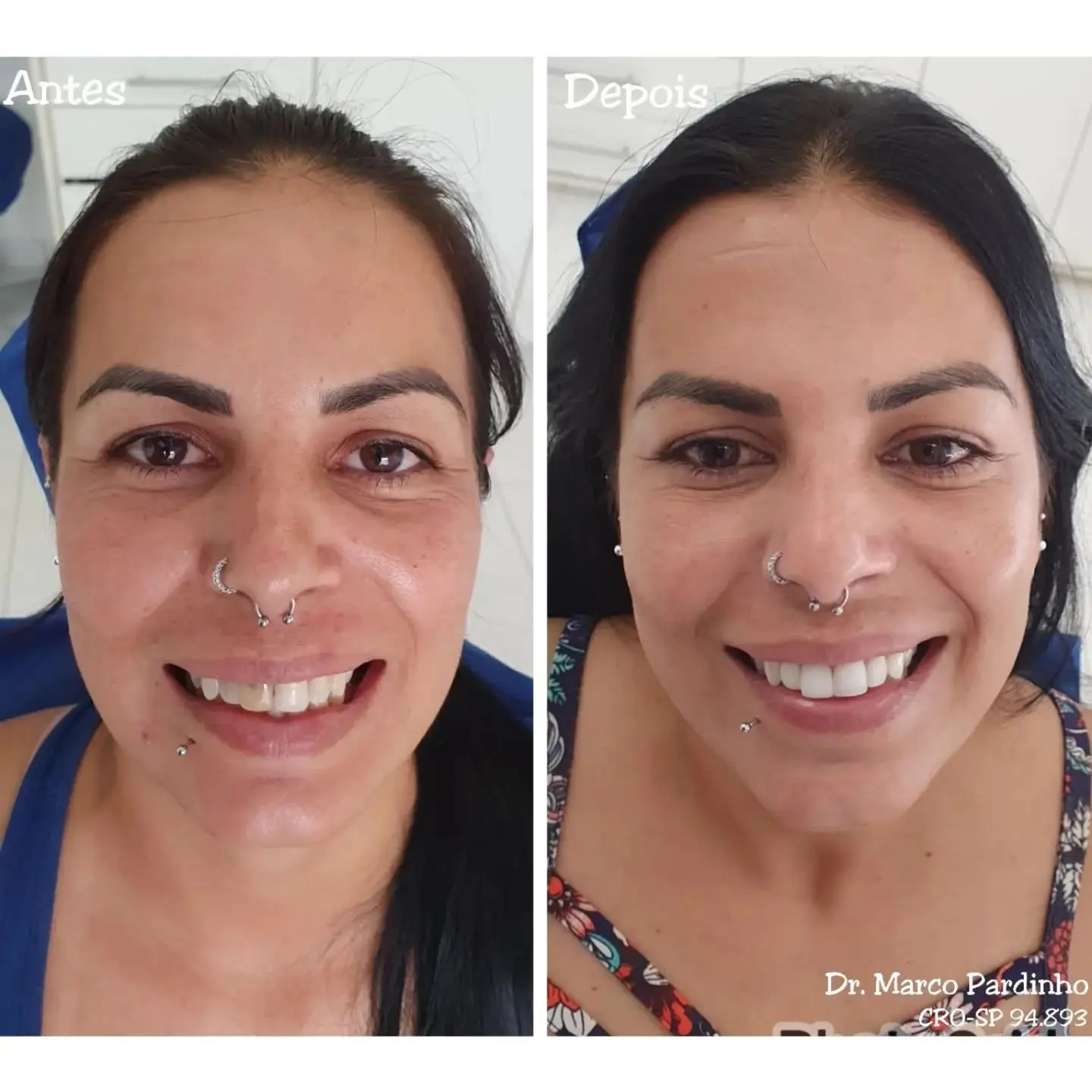 Antes e depois de tratamento com lentes dentais — caso 1