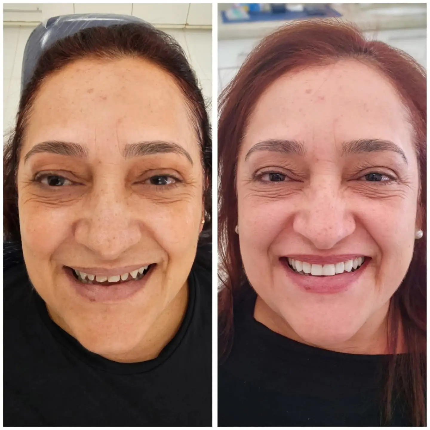 Antes e depois de tratamento com lentes dentais — caso 2