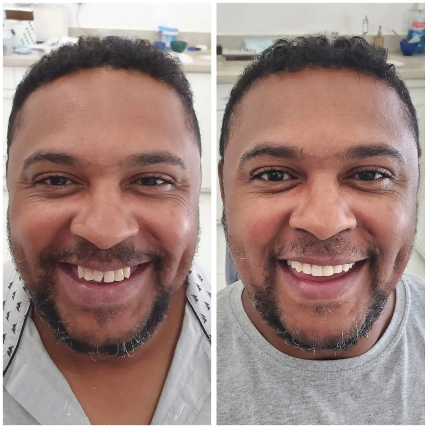 Antes e depois de tratamento com lentes dentais — caso 3