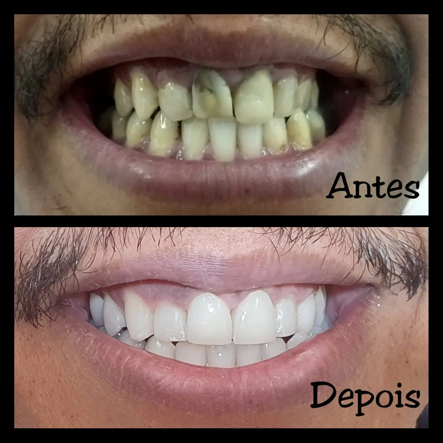 Antes e depois de tratamento com lentes dentais — caso 4