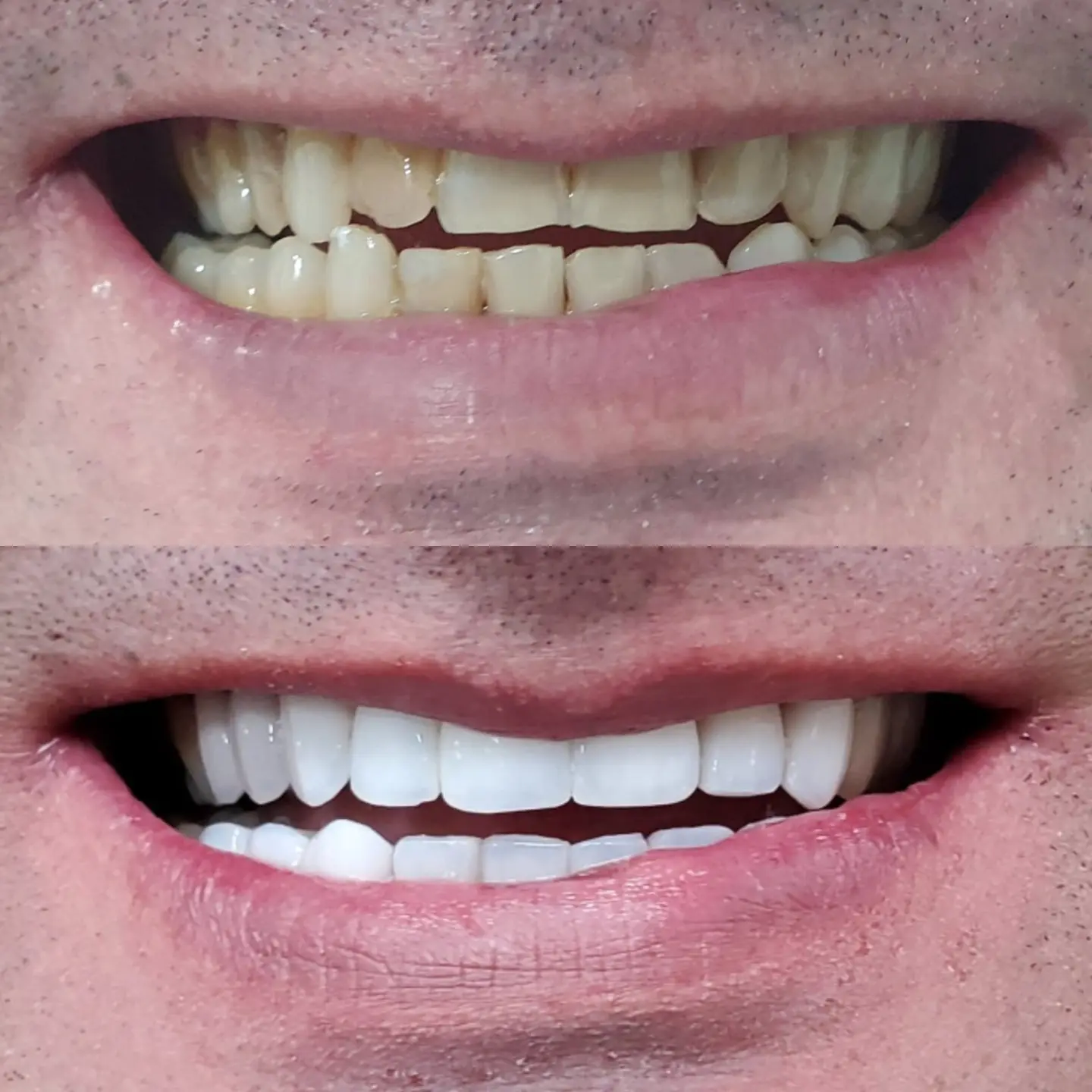 Antes e depois de tratamento com lentes dentais — caso 5