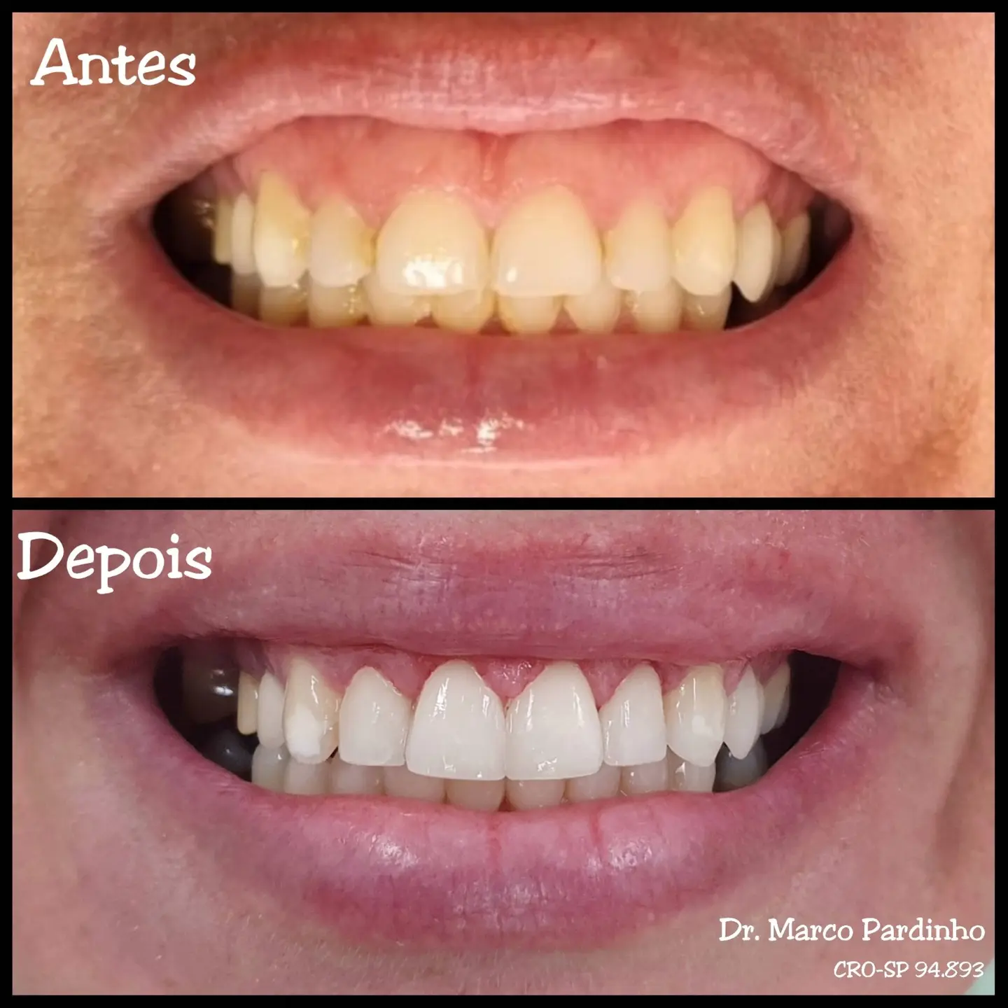 Antes e depois de tratamento com lentes dentais — caso 6