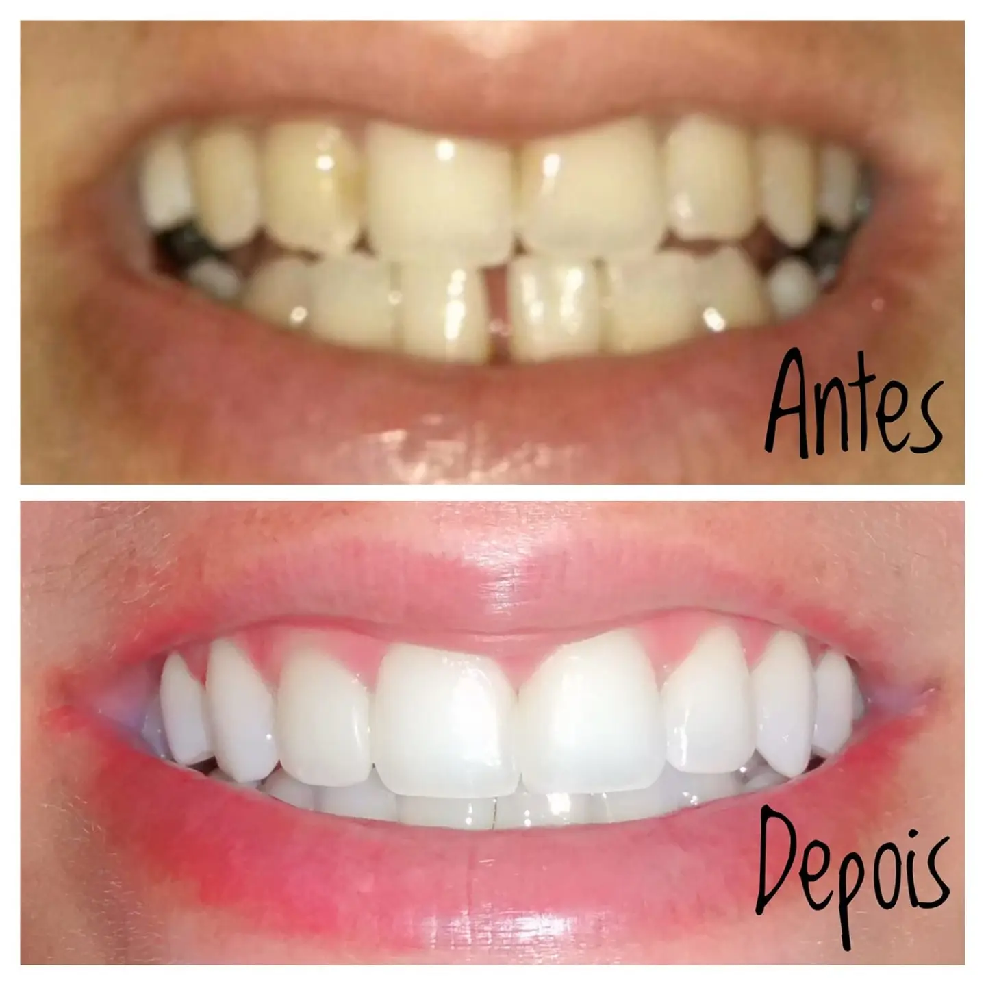 Antes e depois de tratamento com lentes dentais — caso 7