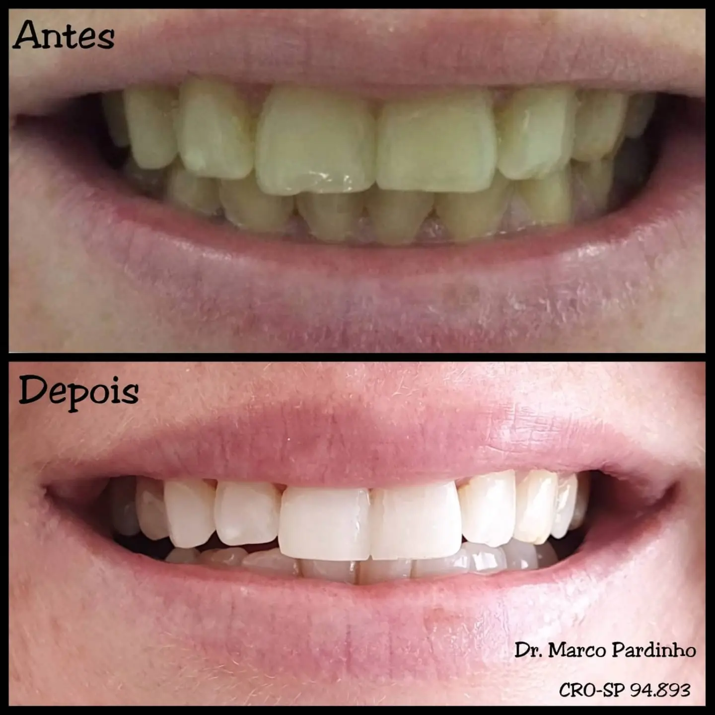 Antes e depois de tratamento com lentes dentais — caso 8