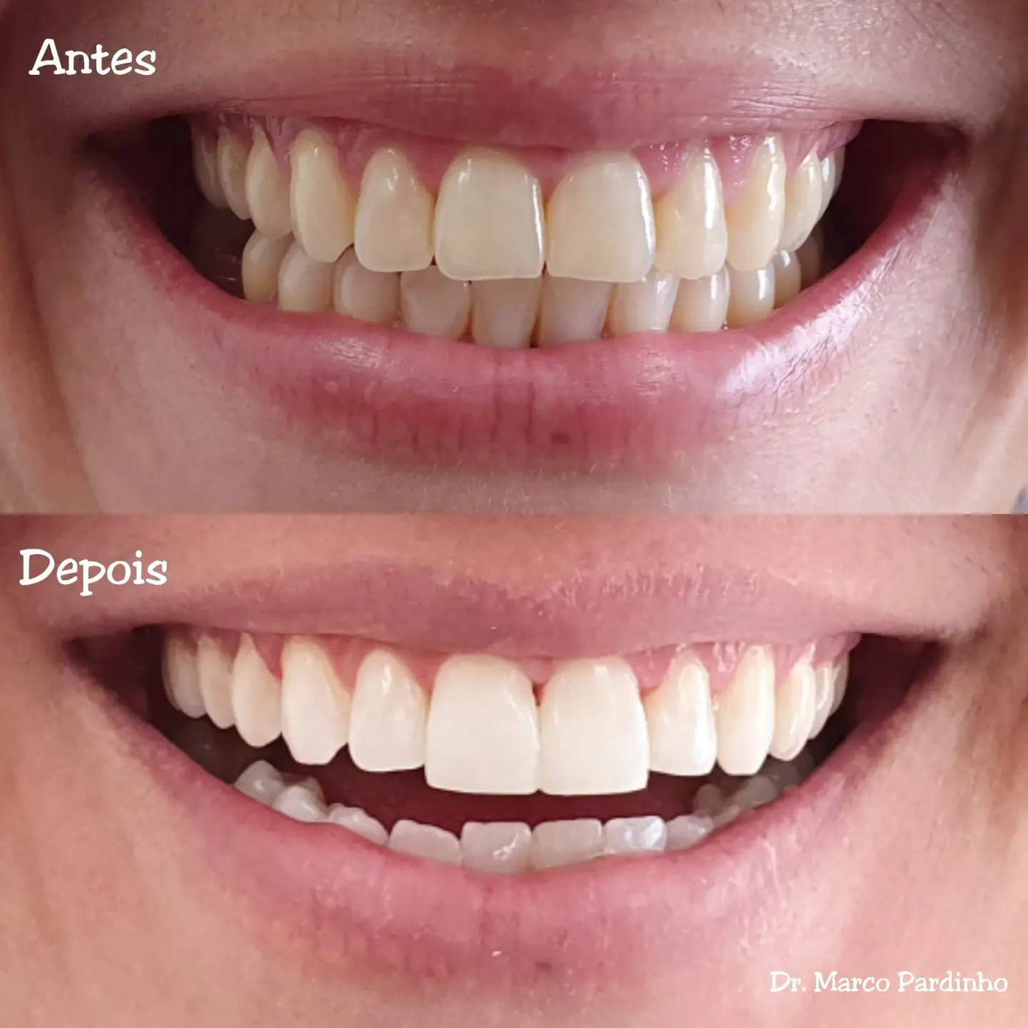 Antes e depois de tratamento com lentes dentais — caso 9