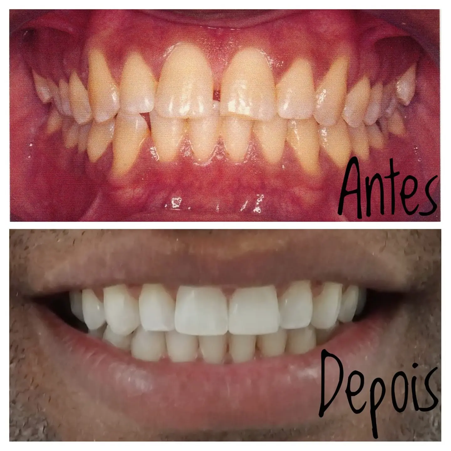 Antes e depois de tratamento ortodôntico — caso 1
