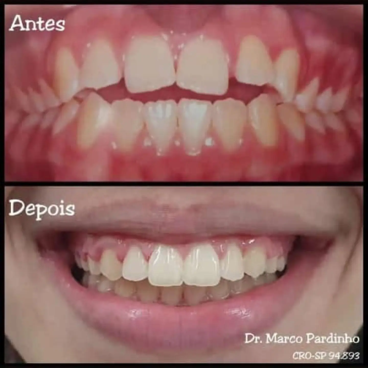Antes e depois de tratamento ortodôntico — caso 2
