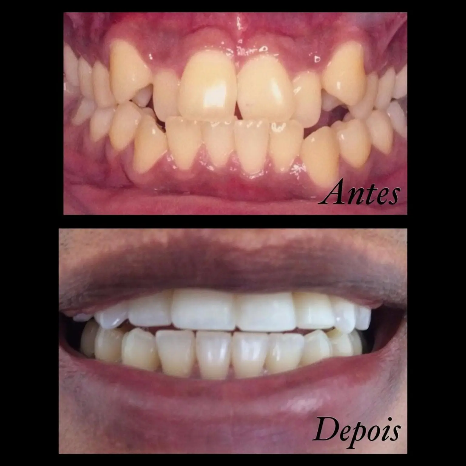 Antes e depois de tratamento ortodôntico — caso 3