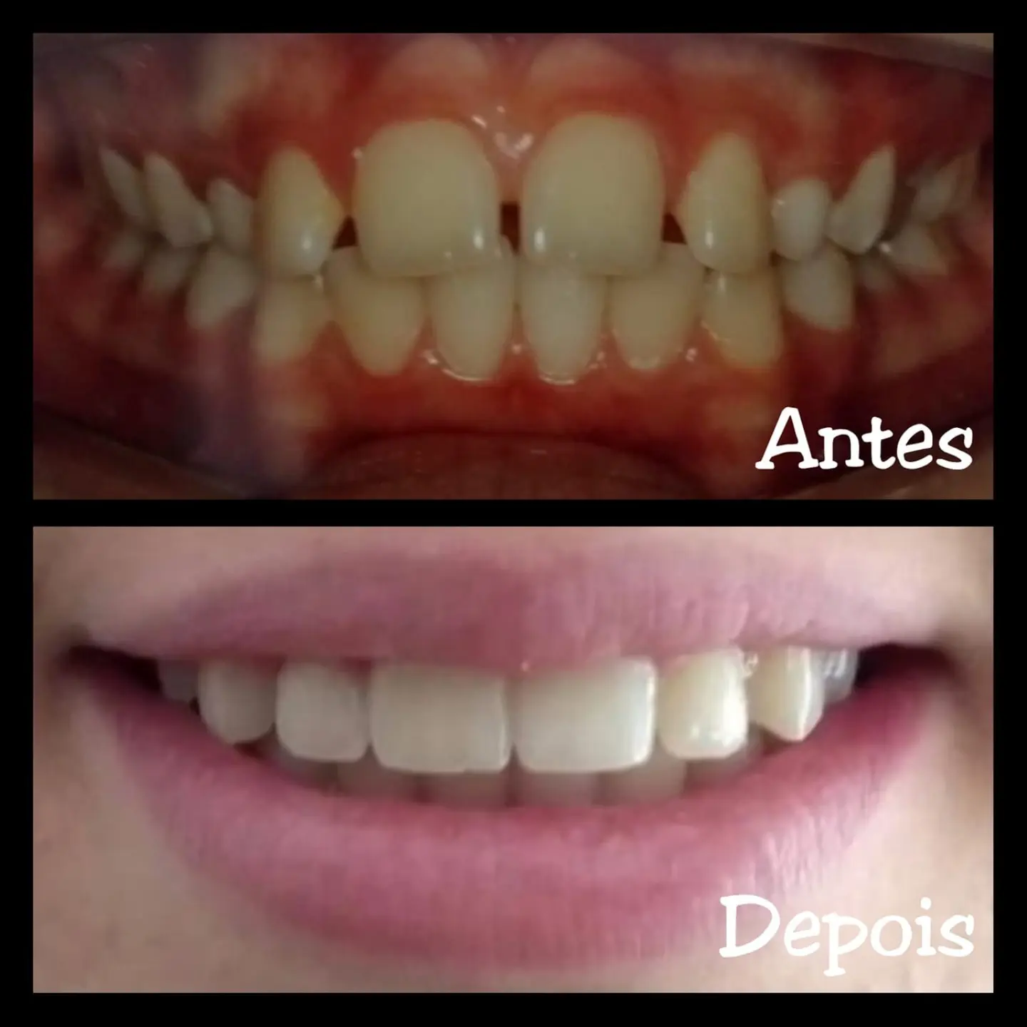 Antes e depois de tratamento ortodôntico — caso 4