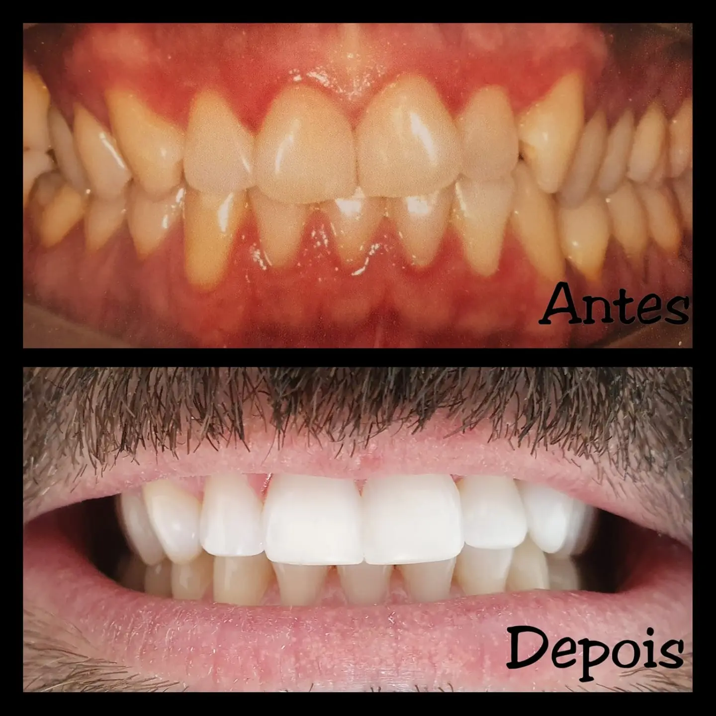 Antes e depois de tratamento ortodôntico — caso 5