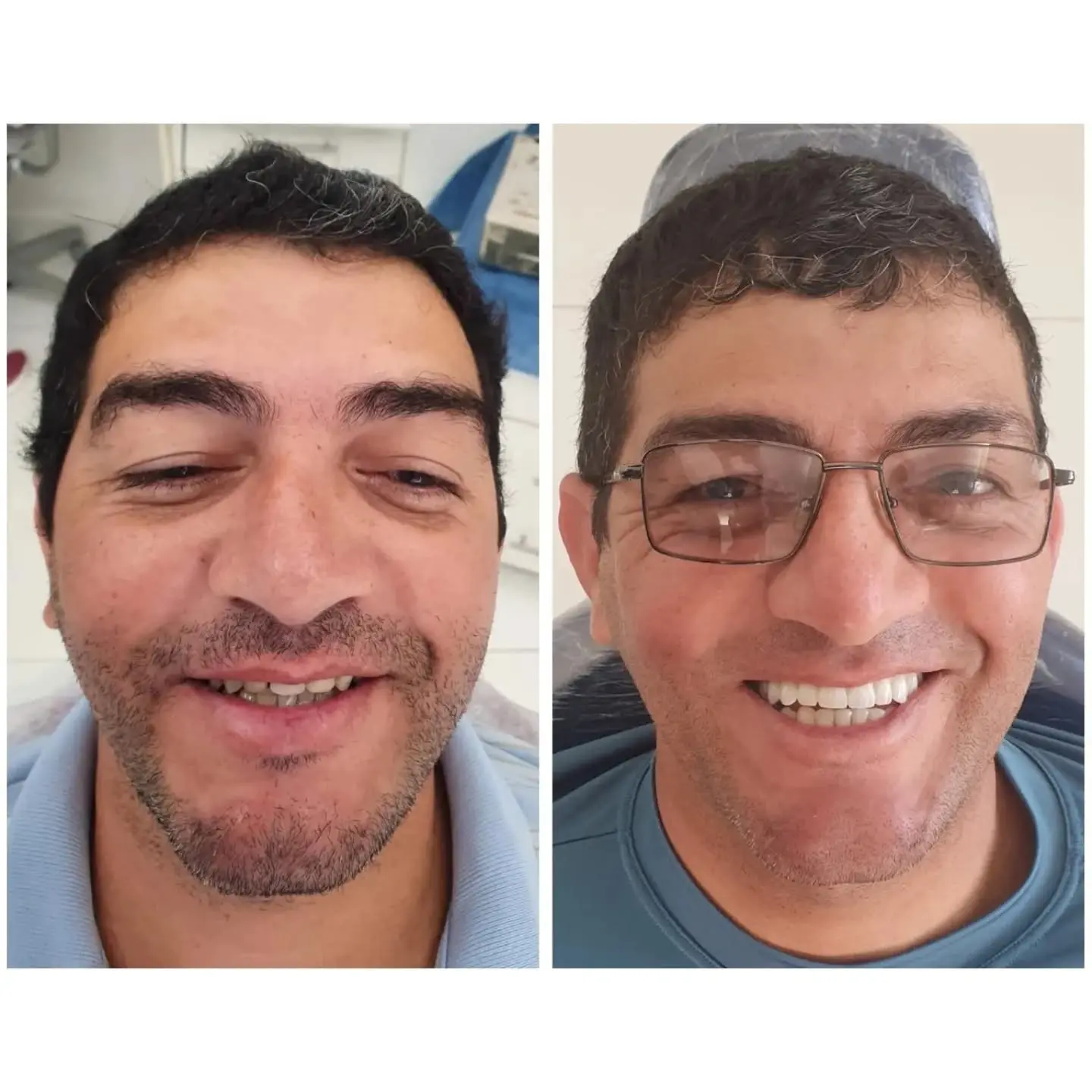 Antes e depois de prótese protocolo — caso 4