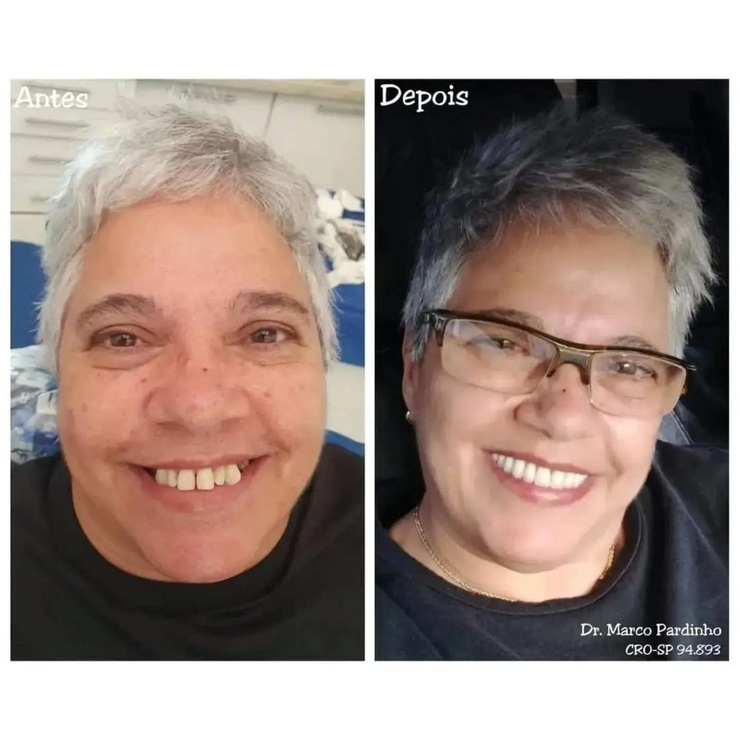 Antes e depois de prótese protocolo — caso 5