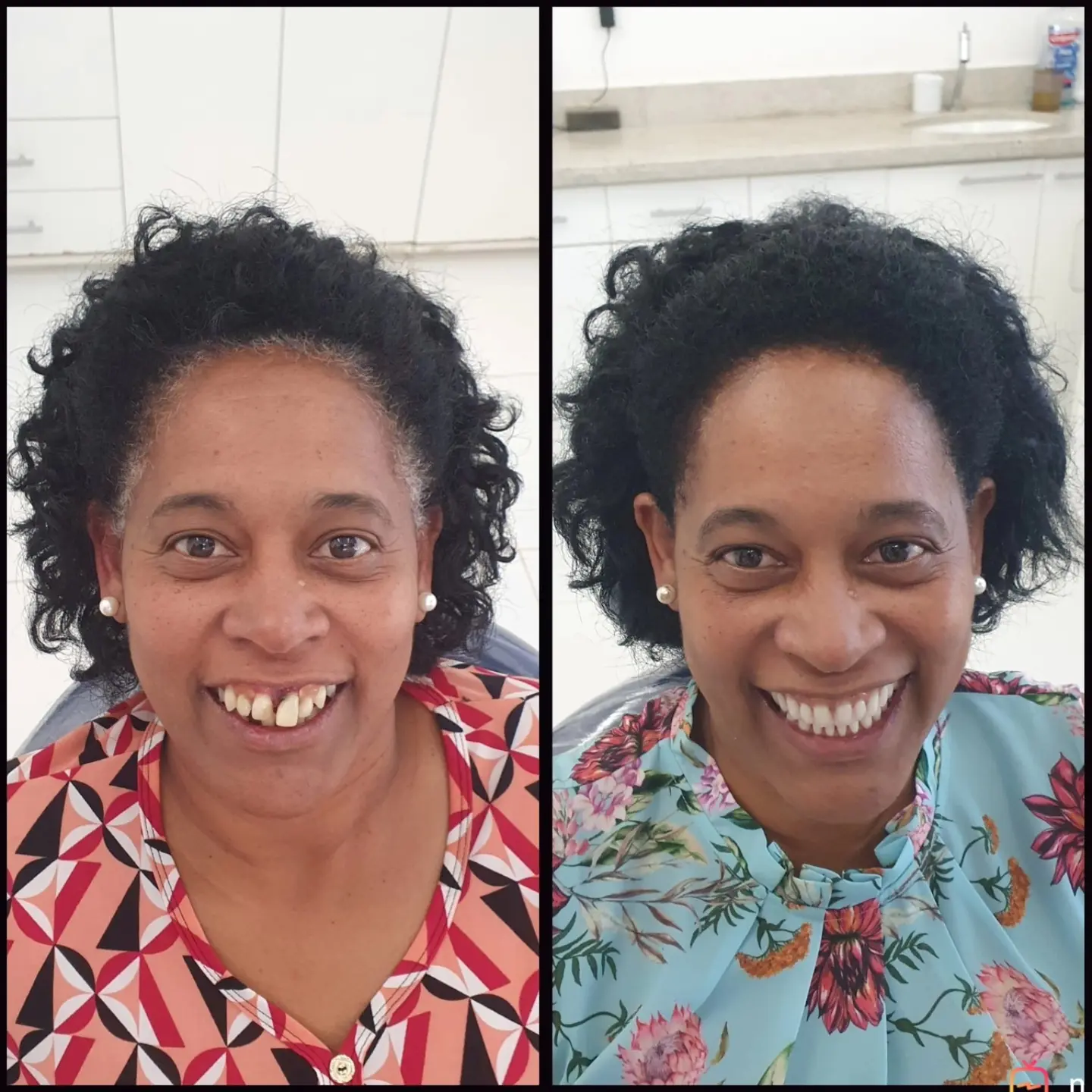 Antes e depois de prótese protocolo — caso 6