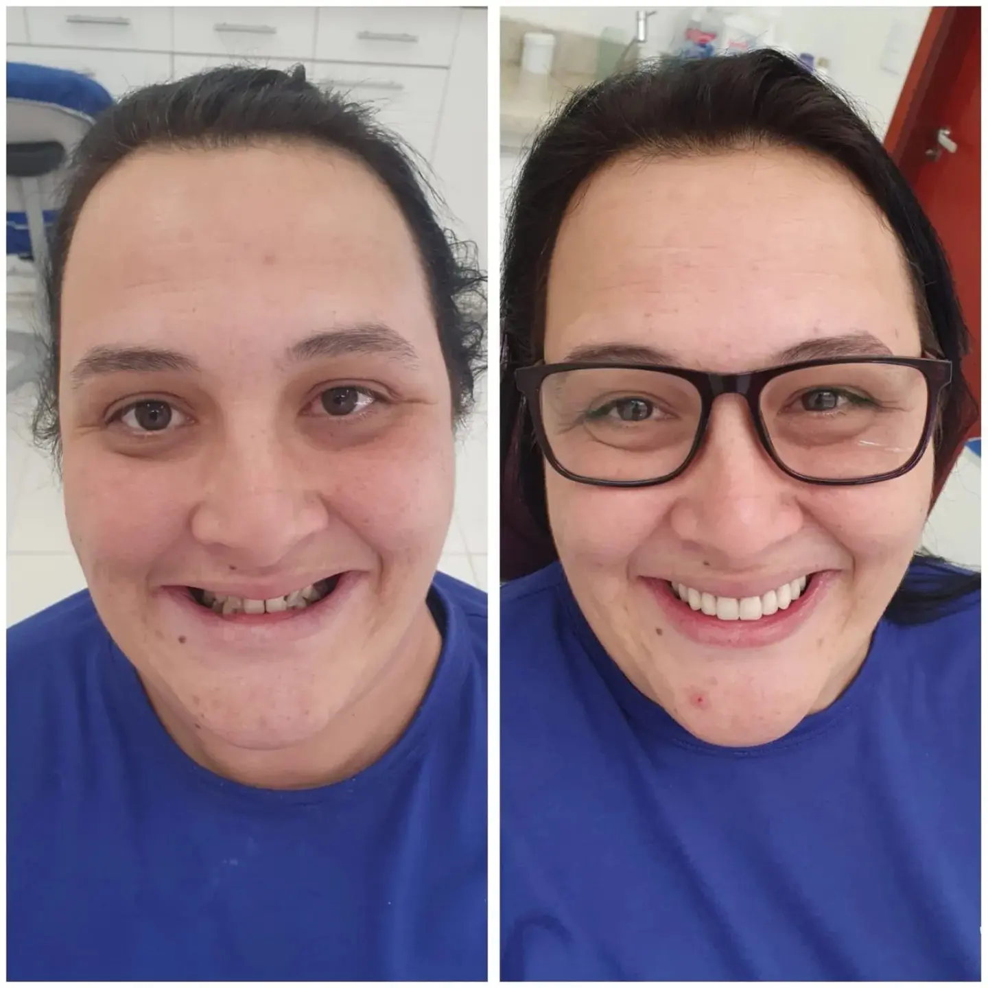 Antes e depois de prótese protocolo — caso 7